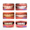 Sérum Blanqueador Dental | V34 BrightSmile Sonrisa Radiante