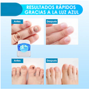 Uñas Perfectas LASER UÑAS DEL PIE Y MANOS - EL MEJOR TRATAMIENTO PARA TUS UÑAS